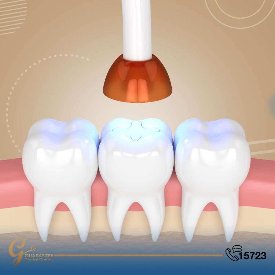 حشوة تجميلية كومبوزيت لكامل السن + تنظيف سطحي للتسوس