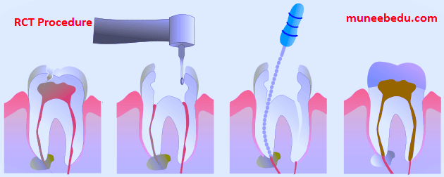 R.C.T. With Amalgam Filling