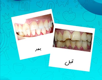 معالجة لثوية بسيطة