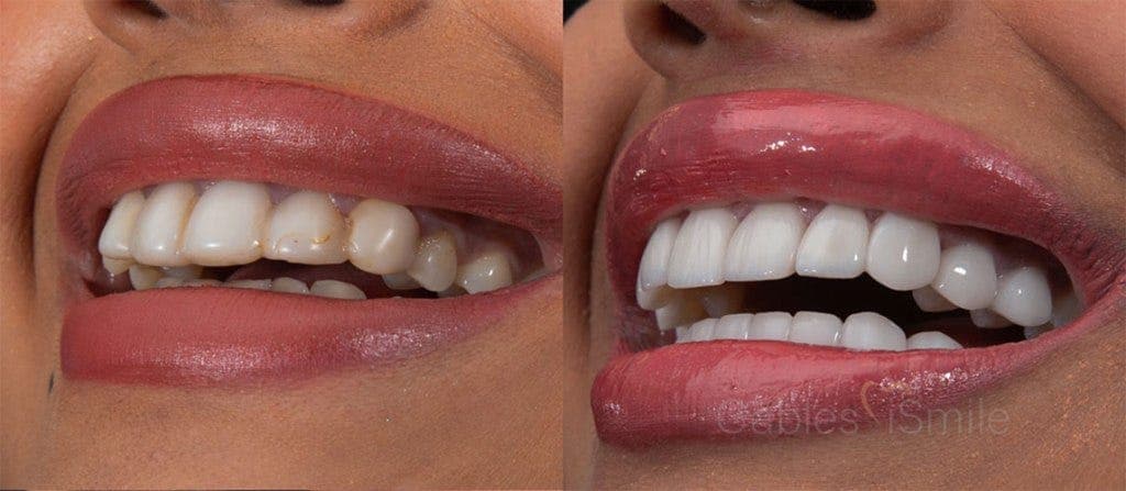 ابتسامة هوليوود بعدسات الإيماكس لـ16 سن تبدا من 