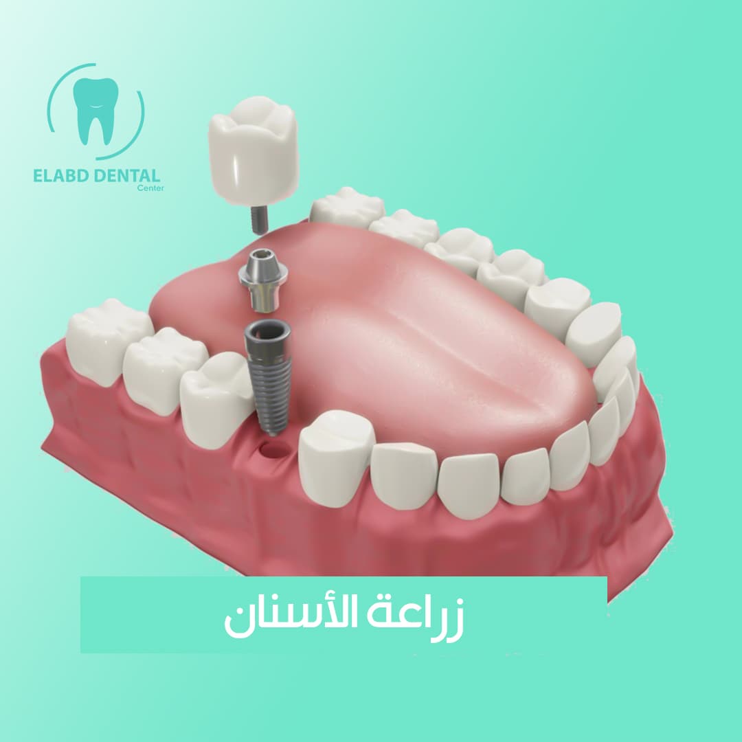 زرعة بيرايزون امريكية بدون التركيبة
