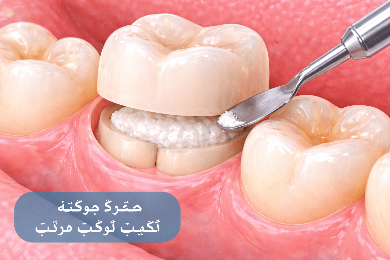 اعادة تثبيت تاج