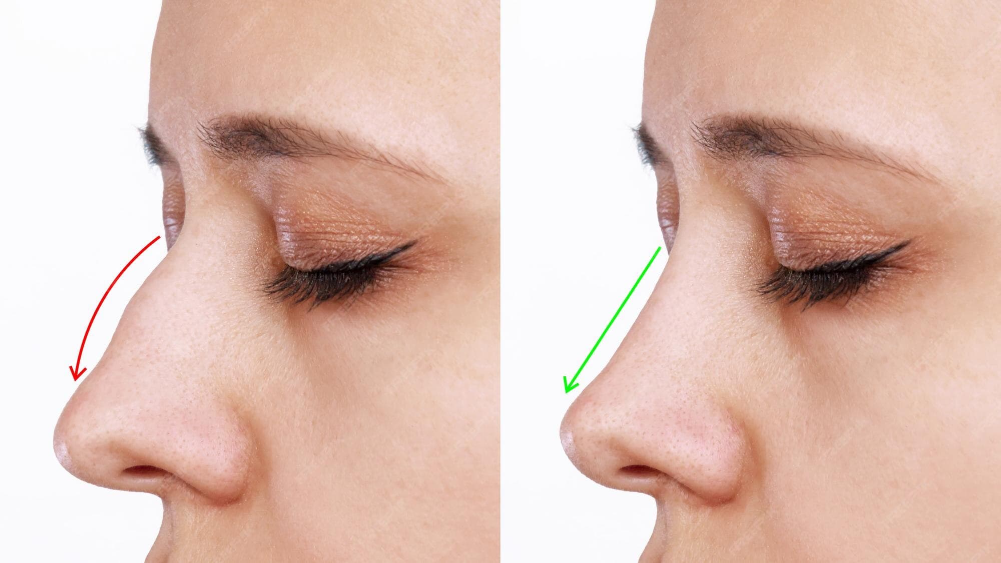 عملية تجميل الأنف