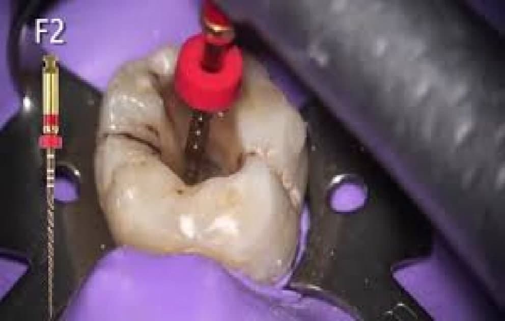 علاج عصب بإستخدام جهاز الروتارى أول