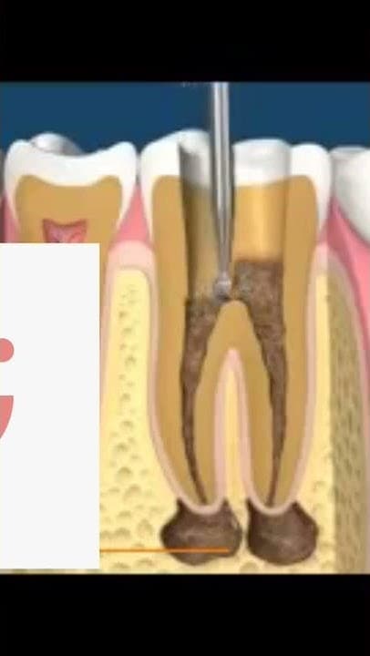 عمل دعامة بعد علاج الاعصاب