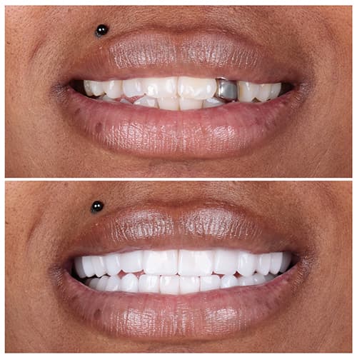 ابتسامة E-MAX 3D  (للسن الواحد )