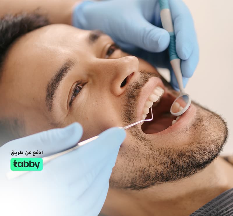 تبييض اسنان وتنظيف + تلميع