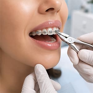 فك التقويم مع تنظيف وتلميع